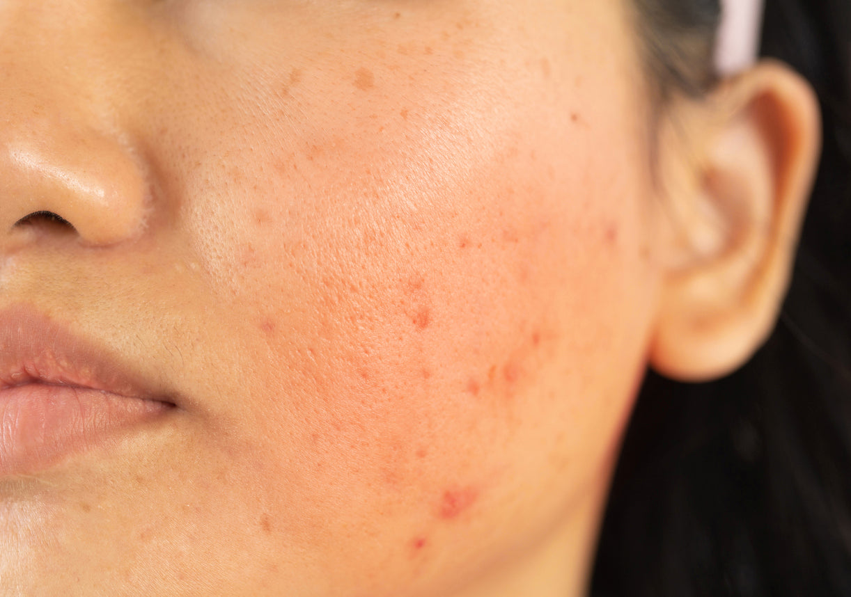 Treat facial blemishes and imperfections | Flawless Body